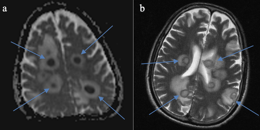 MRI brain showing multiple brain abscesses with surrounding edema arrows (a: diffusion, b: T2) 
