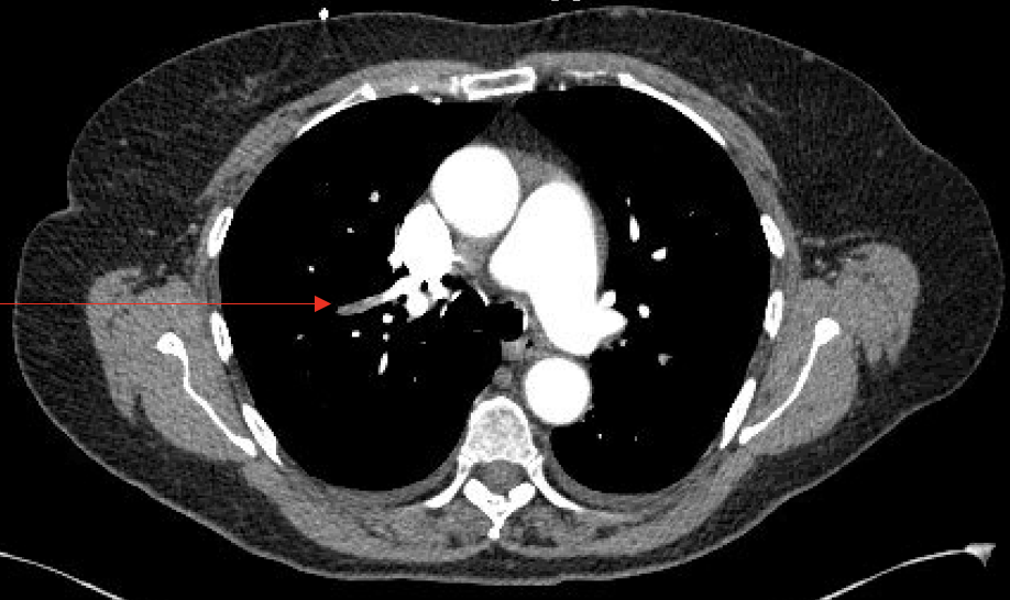 CT-PE chest with IV contrast showing filling defect in the right pulmonary artery involving the posterior segment of the upper lobe consistent with pulmonary embolism (red arrow pointing at the filling defect).