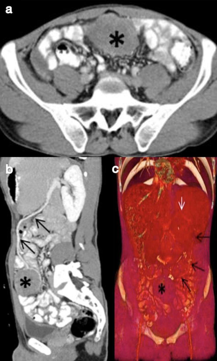 (A), Axial computed tomography of the abdomen in axial section showing omental mass, (B), sagittal section of the tomography where the omental vein is observed reaching what would be the omental mass. (C), coronal section where it is observed that the omental vein drains to the splenic vein.