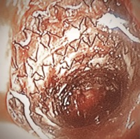 16x40 mm metal stent visualized covering the tracheoesophageal fistula.