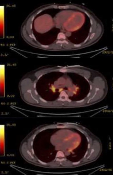 FDG-PET scan of the heart, showing curvilinear FDG uptake throughout the left ventricular (LV) myocardium including the free wall and interventricular septum, and a slightly more intense focal uptake at the interventricular septum.