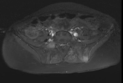 High STIR and low T1 signal with enhancement post contrast in left iliac bone