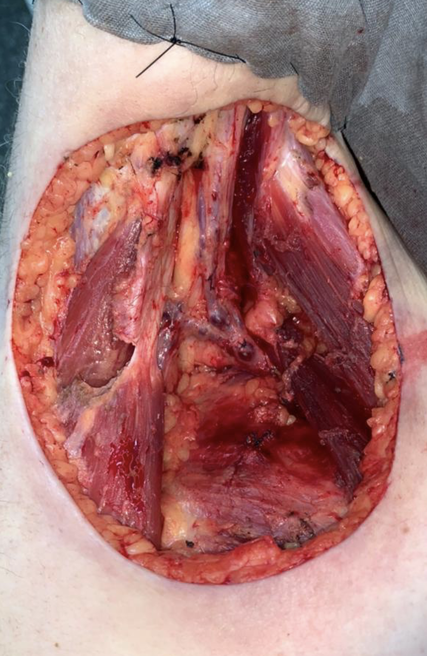 Post Resection of Right Axillary Lesion with 2 cm Margin