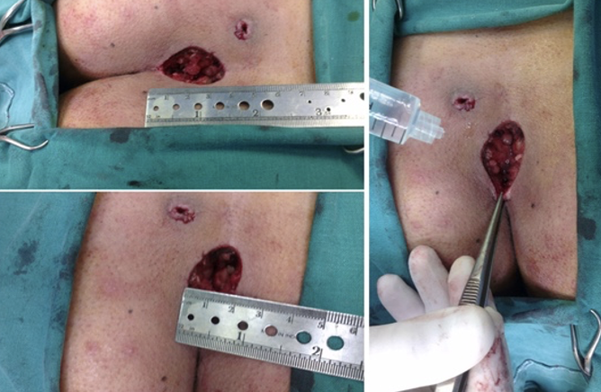 Intraoperative measurements (length, width and volume).